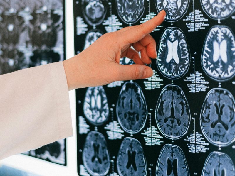 A doctor's hand points to a brain MRI scan on a lightbox, illustrating medical diagnosis.