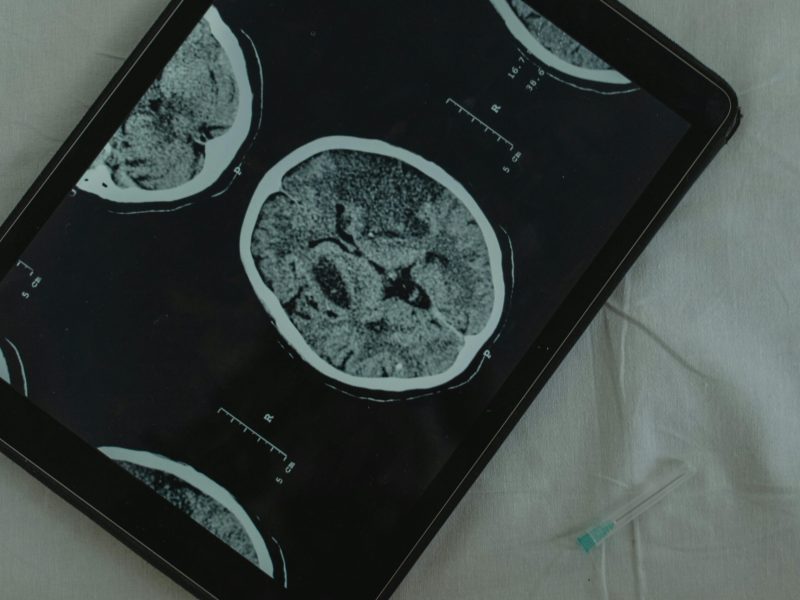 Close-up view of a brain CT scan displayed on a digital tablet with a medical needle beside it.